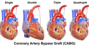 Coronary Artery Bypass Graft