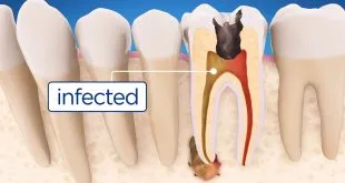 root canal treatment