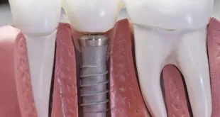 Dental Implants