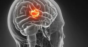 Treatment For a Skull Tumor