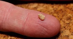 kidney stone treatment