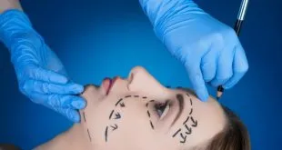 Face Lift Surgery