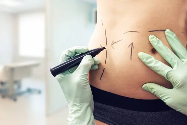 Tummy Tuck