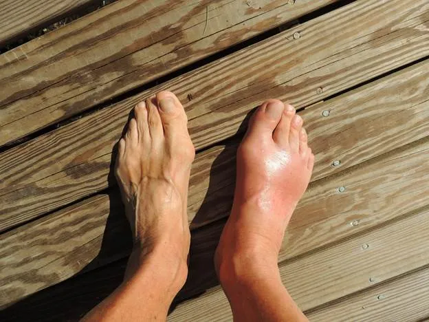What Foods Cause Gout
