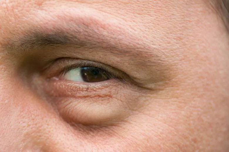 Eye Health