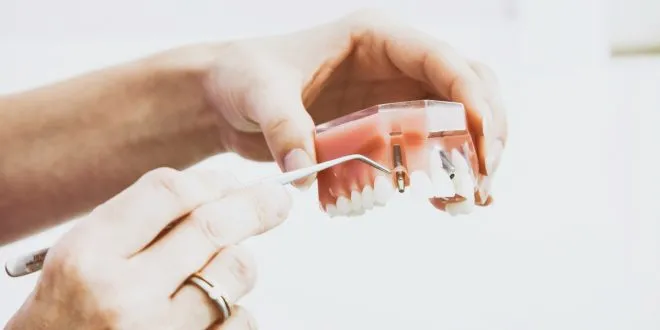 dental implant