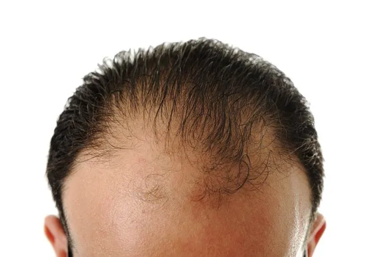 Hair Restoration